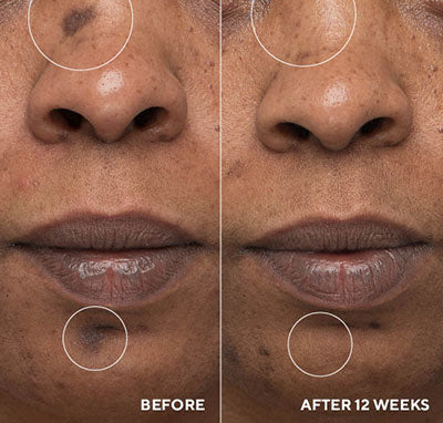 HydroPeptide InnerDerm Rx Before and After